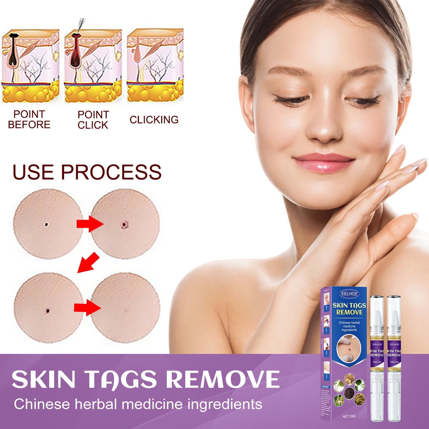 WART REMOVER LQ 17% 15ML