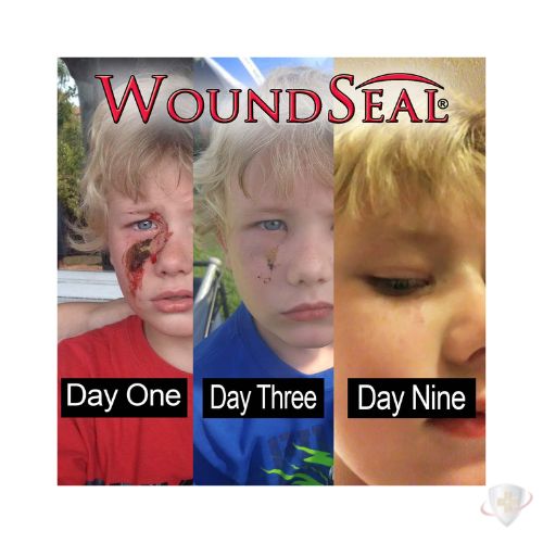 WOUNDSEAL W/APPLICATOR PWD 4CT