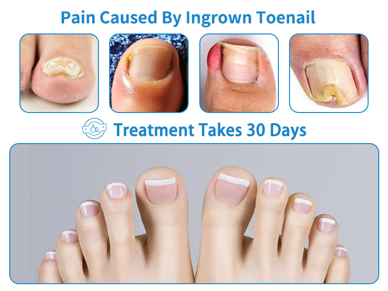 SCH INGROWN TOENAIL KT 1% PN/RLV