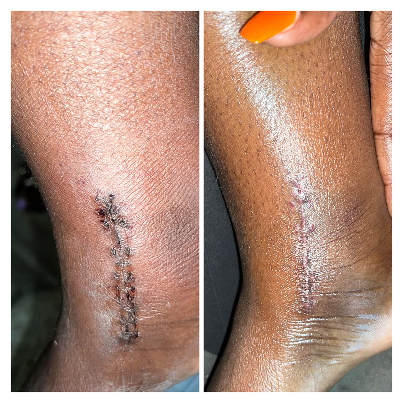 PALMERS COCOBTR SCAR SERUM   1Z