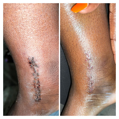 PALMERS COCOBTR SCAR SERUM   1Z