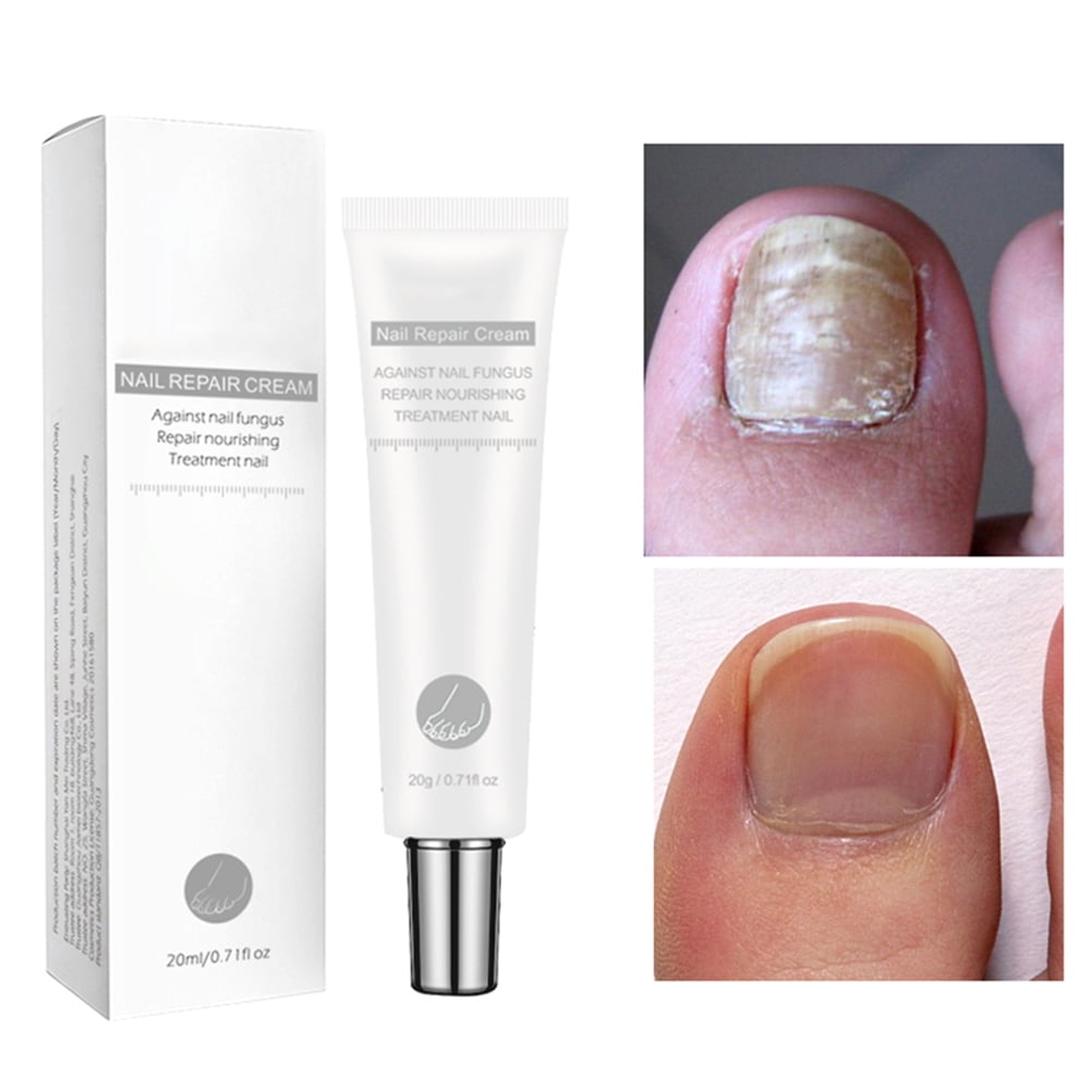 NAIL FUNGUS CONTROL,OG2