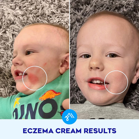 KIDS,ECZEMA CREAM