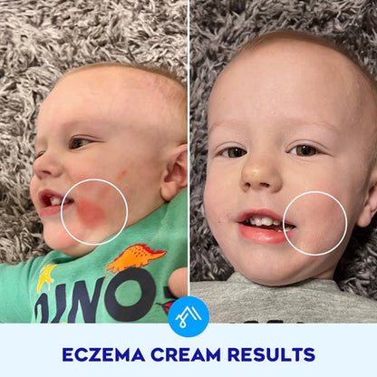 KIDS,ECZEMA CREAM