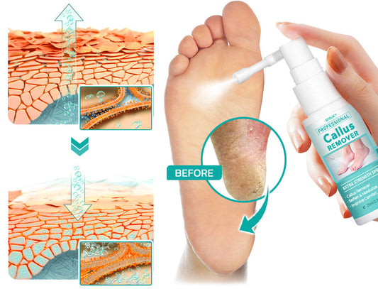 CALLUS REMOVER GL 177ML