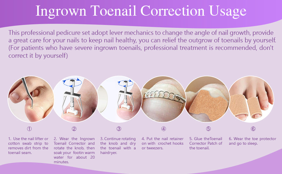 SCH INGROWN TOENAIL KT 1% PN/RLV