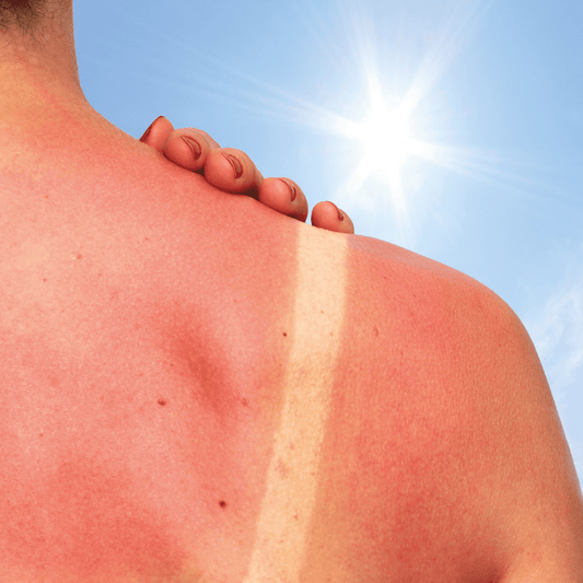 AVOID EXPOSURE TO SUN LL
